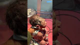 Different Types of Newborn medical viralvideo [upl. by Nonnahc517]