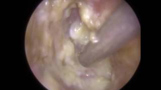 Glue Ear amp ETD in Revealed After Ear Wax Removal  Mr Neel Raithatha THC [upl. by Tatum]