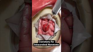 Removing pooled blood from the brain 3D Animation [upl. by Clarhe]