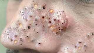 Big Cystic Acne Blackheads Extraction Blackheads amp Milia Whiteheads Removal Pimple Popping  9198 [upl. by Laehcim]