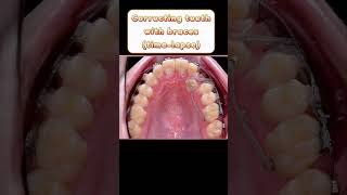 Correcting teeth with braces timelapse teethbraces orthodontics shorts [upl. by Kreis29]