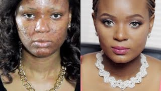 My Skin Care Miracle How I Got Rid of Acne Acneorg quotThe Regimenquot [upl. by Moe325]