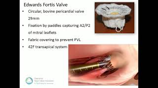 11001115 Transcatheter Mitral Valve Replacement Anson Cheung MD [upl. by Lydnek]