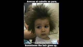 Brown Uncombable Hair Syndrome [upl. by Anilas]