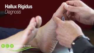 Hallux Rigidus Causes Diagnosis and Treatment [upl. by Arvie]