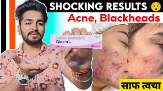 Glocin Gel Review  Best Cream For Acne Pimples Blackheads [upl. by Vincenty687]