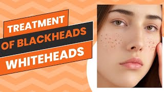 Treatment of blackheads whiteheads  how to treat blackheads whiteheads [upl. by Dorahs64]