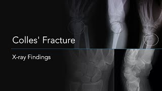 Colles Fracture Xray Findings [upl. by Ahouh]