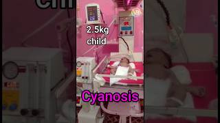 Cyanosis On the cpap😳😱newborn nicu baby shorts ytshorts cpap childvideo newbornill [upl. by Knobloch]