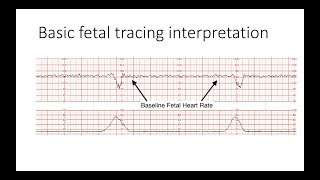 Interpreting Intrapartal fetal heart rate tracings [upl. by Aramak]