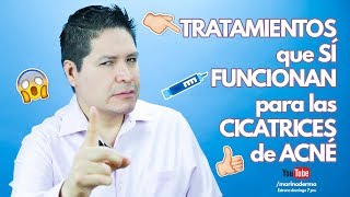 TRATAMIENTOS QUE SÍ FUNCIONAN EN CICATRICES DE ACNÉ [upl. by Lotta]