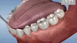 Endodonti Kanal Tedavisi [upl. by Nosnhoj]