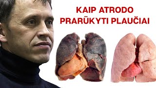 Kaip atrodo prarūkyti plaučiai [upl. by Jorie]