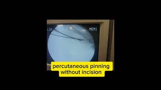 fracture metacarpalclose reduction percutaneous pinning [upl. by Ennagrom736]