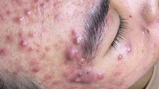 Big Cystic Acne Blackheads Extraction Blackheads amp Milia Whiteheads Removal Pimple Popping  5044 [upl. by Etireugram]