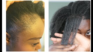 Is Traction Alopecia Reversible [upl. by Charity]