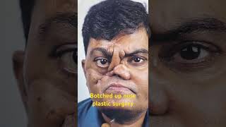 Botched NOSE plastic surgery done in another hospital corrected by Dr Sunil Richardson [upl. by Jaret]