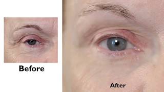 Instant FIRMx Eye Treatment How To [upl. by Eniamret785]