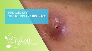 Inflamed Cyst Extraction and Drainage [upl. by Acirema864]