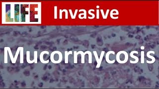 Mucormycosis [upl. by Alakim405]