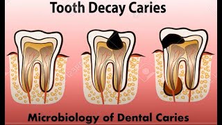 Histopathology of dental caries Functions of saliva [upl. by Adeuga563]