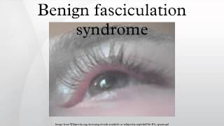 Benign fasciculation syndrome [upl. by Older]