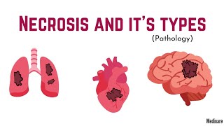 Necrosis  Made very easy  Pathology  Medinare [upl. by Merow952]