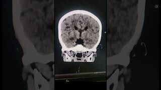 Corpus Callosum Agenesis  Radiology [upl. by Beaufort]