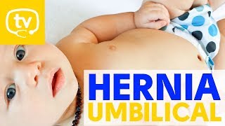 Hernia umbilical en los bebés [upl. by Bohlin]