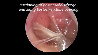 Endoscopic Myringotomy Suctioning of Middle Ear Mucous and Grommet Insertion [upl. by Ardnoik112]