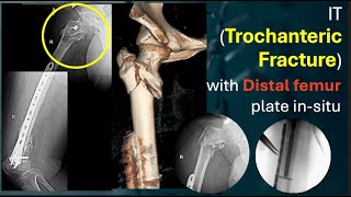 IT Trochanteric Fracture with Distal Femur Plate in Situ [upl. by Ladew300]