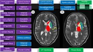 MRI Brain Sectional Anatomy Cut 9 amp 10 [upl. by Otis]