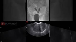 Bicornuate or Septate Uterus radiology ultrasound [upl. by Towne]