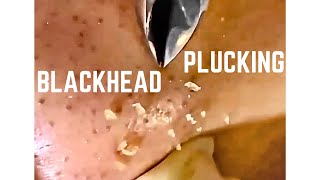 Blackhead plucking tweezer giant holes on skin silent peaceful relaxing satisfying 拔黑头粉刺 巨大毛孔 [upl. by Eylhsa]