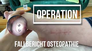 Operation des Sprunggelenks  osteochondrosis dissecans Falllbericht [upl. by Leahcimnaes]