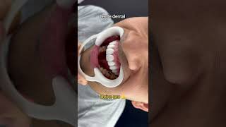 dentes odontologia dentista dentist dentistica dentistasp dentico dentistry bracket [upl. by Pilif]