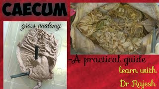 CAECUM  Specimen demo [upl. by Aleibarg]