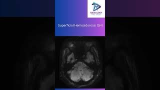 Superficial HemosiderosisSuperficialHemosiderosisNeuroRadiologyMRIImaging SusceptibilityMRI [upl. by Ogdan]