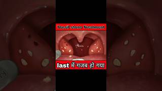 quotTonsil stone का ईलाज कैसे किया जाता हैं quot 3d animation video shorts [upl. by Mitchel486]