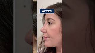 Rhinoplasty Before and After  Nose Job in Turkey  Rhinoplasty Surgeon [upl. by Humbert124]