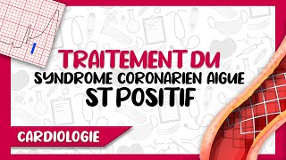 Prise en Charge amp Traitement du Syndrome Coronarien Aigu avec Segment ST Positif [upl. by Donal]