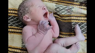 Newborn baby born as Breech after birth who has flexible feet [upl. by Eityak]