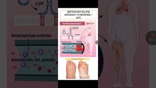 Antiphospholipid Antibody Syndrome [upl. by Asoj]