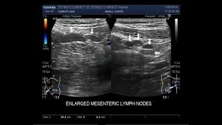 Ultrasound Video showing multiple enlarged lymph nodes ie Lymphadenopathy [upl. by Bloom]