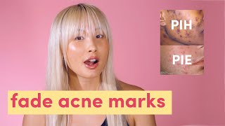 Fade acne marks Post inflammatory hyperpigmentation amp post inflammatory erythema  PIH amp PIE [upl. by Atile75]