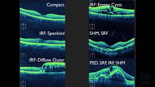 Macular OCT Interpretation A Practical Discussion with Dr David E Lederer [upl. by Avihs]