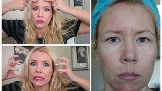 25 YEARS OF SKIN PICKING Dermatillomania  BEAUTY OVER 40 [upl. by Juditha]