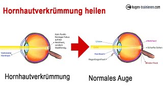 Hornhautverkrümmung heilen  effektive Augenübung um die Sehkraft zu verbessern [upl. by Gerius]