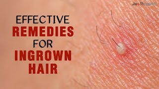 10 Effective Remedies For Ingrown Hair [upl. by Seumas]