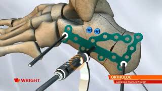 ORTHOLOC CALCANEAL FRACTURE PLATING SYSTEM [upl. by Ajin993]